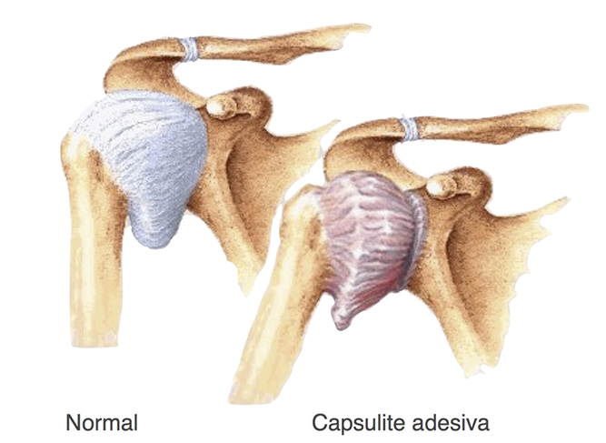capsulite adesiva do ombro